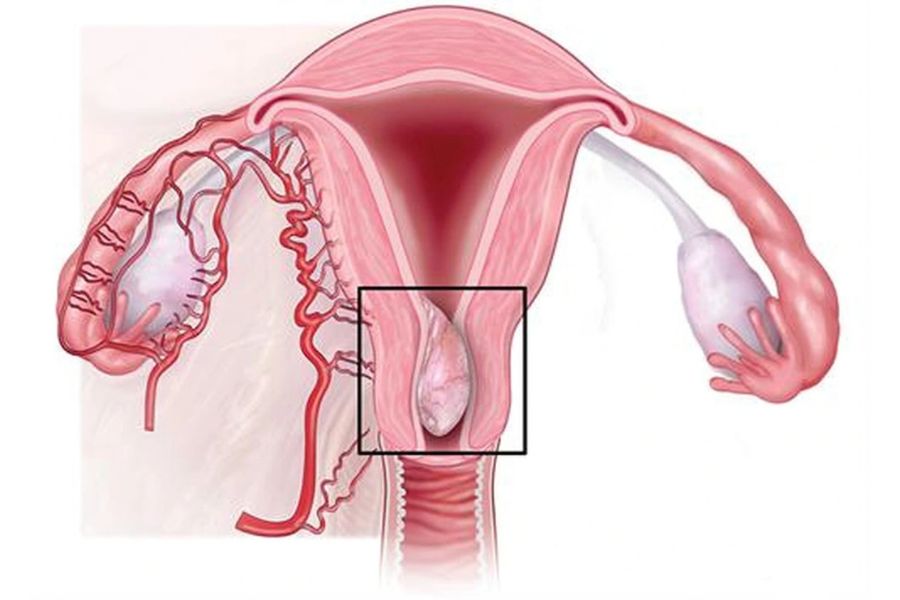 Polyp cổ tử cung là khối mô nhỏ phát triển ở cổ tử cung, phần lớn là lành tính