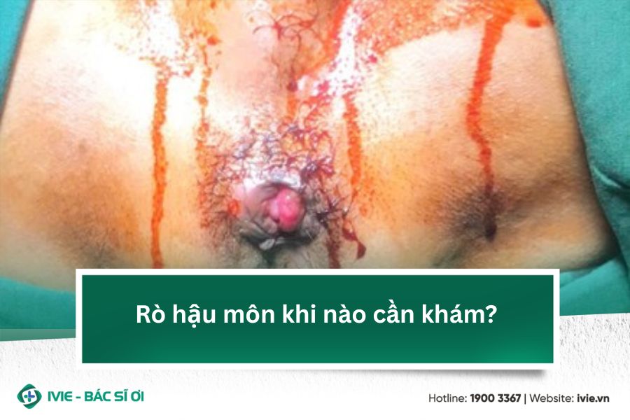 Rò hậu môn khi nào cần khám?