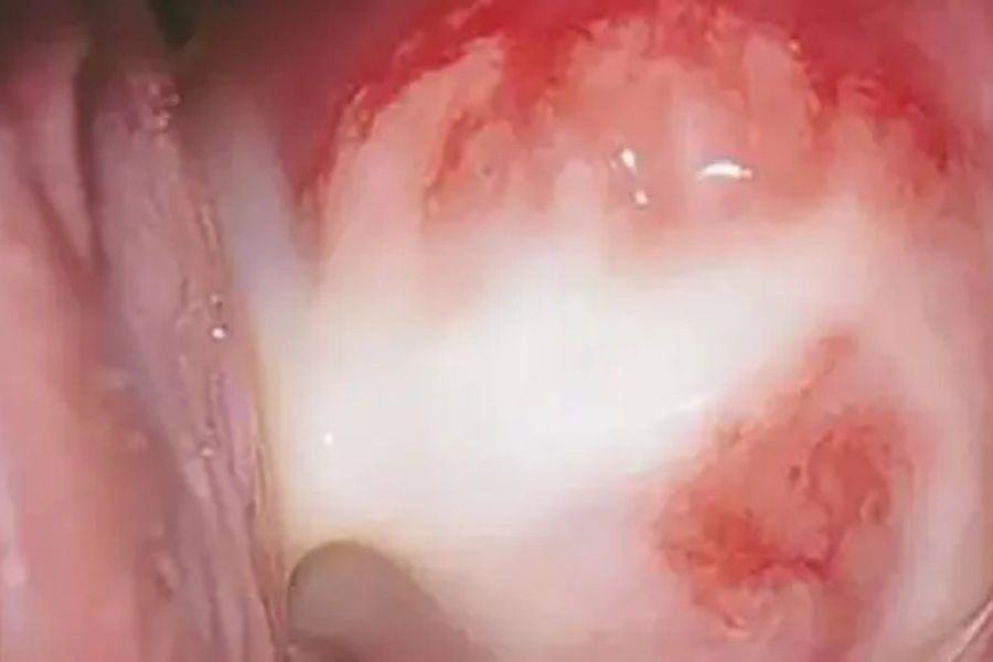 Chlamydia ở nữ là nhiễm trùng đường sinh dục do vi khuẩn, thường không có triệu chứng rõ ràng