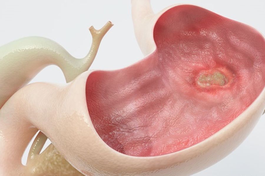 Viêm dạ dày mạn tính có thể gây loét, xuất huyết và làm tăng nguy cơ ung thư dạ dày ở một số trường hợp