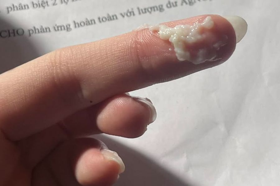 Khí hư vón cục như bã đậu là dấu hiệu cảnh báo mất cân bằng hệ vi sinh âm đạo