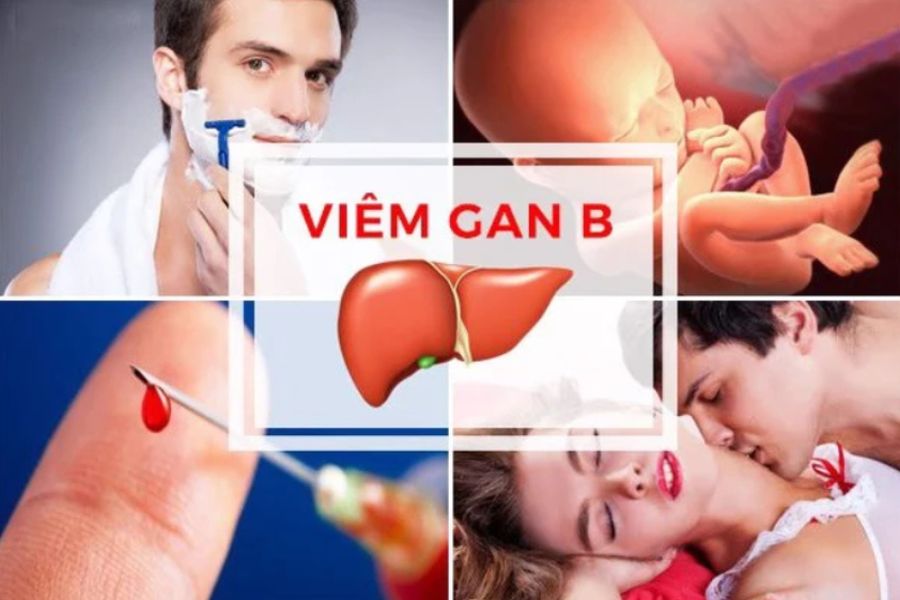 5 con đường lây nhiễm chính của virus viêm gan B mà mỗi người cần lưu ý