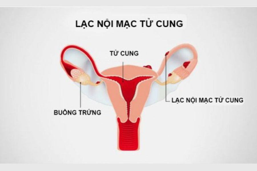 Lạc nội mạc tử cung gây viêm dính vòi trứng và buồng trứng, ảnh hưởng trực tiếp đến khả năng thụ thai