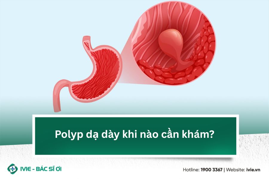 Polyp dạ dày khi nào cần khám?