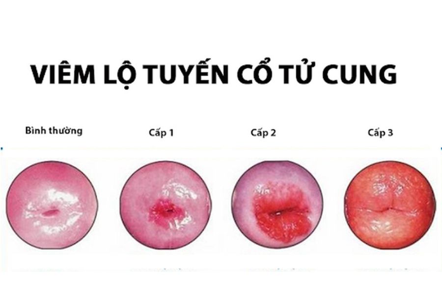 Nhận biết sớm các giai đoạn viêm lộ tuyến cổ tử cung giúp quá trình điều trị đạt hiệu quả cao hơn