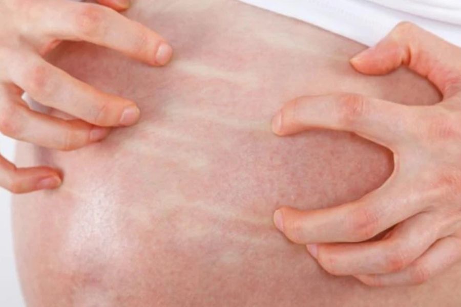 Triệu chứng ngứa đặc trưng của ứ mật thai kỳ thường tăng nặng về đêm