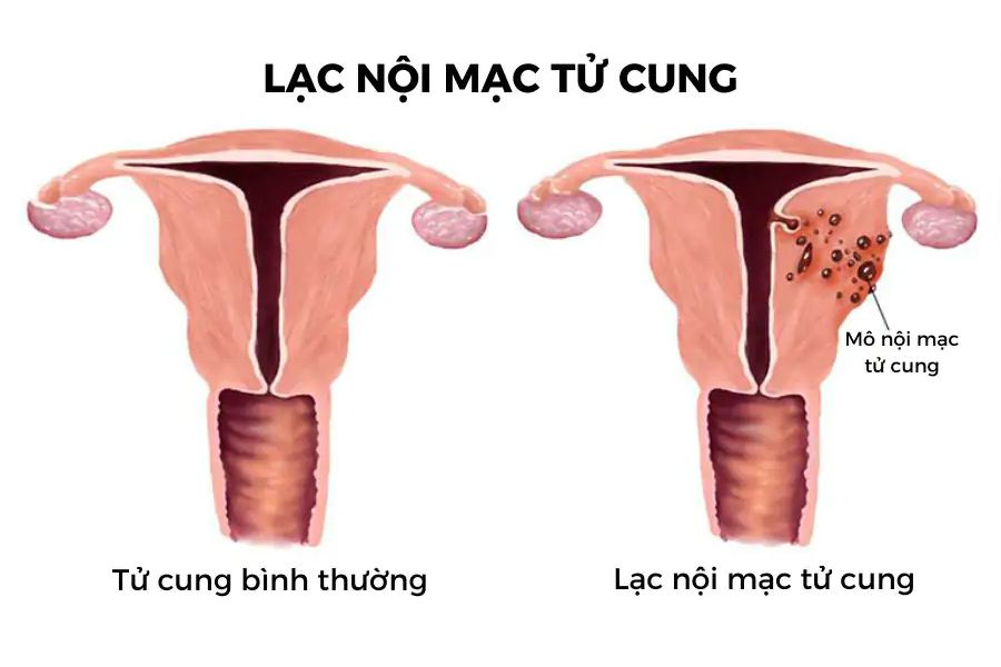Khám phá tổng quan nguyên nhân và các triệu chứng thường gặp của bệnh lạc nội mạc tử cung