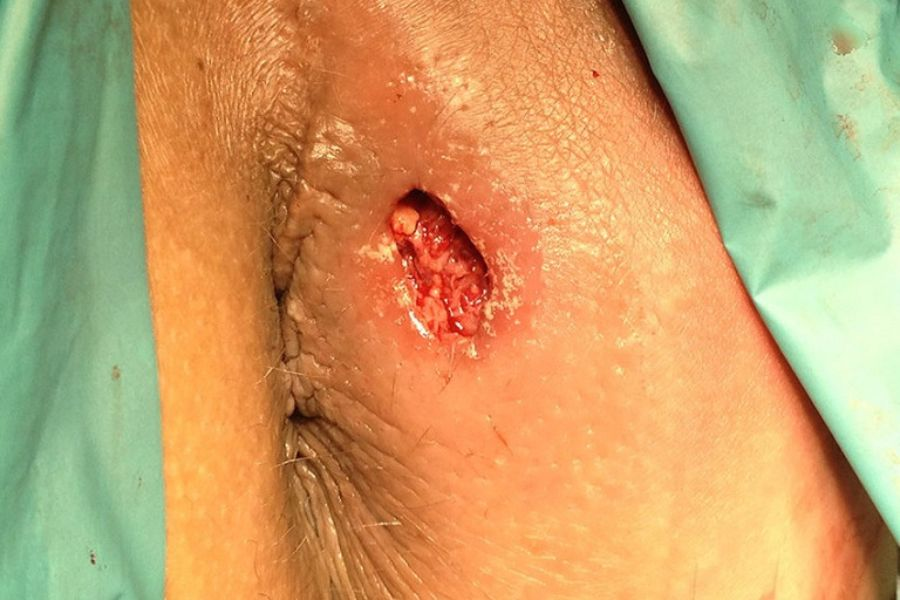Áp xe hậu môn thường do nhiễm trùng tuyến hậu môn; người mắc Crohn, tiểu đường hoặc suy giảm miễn dịch có nguy cơ cao hơn