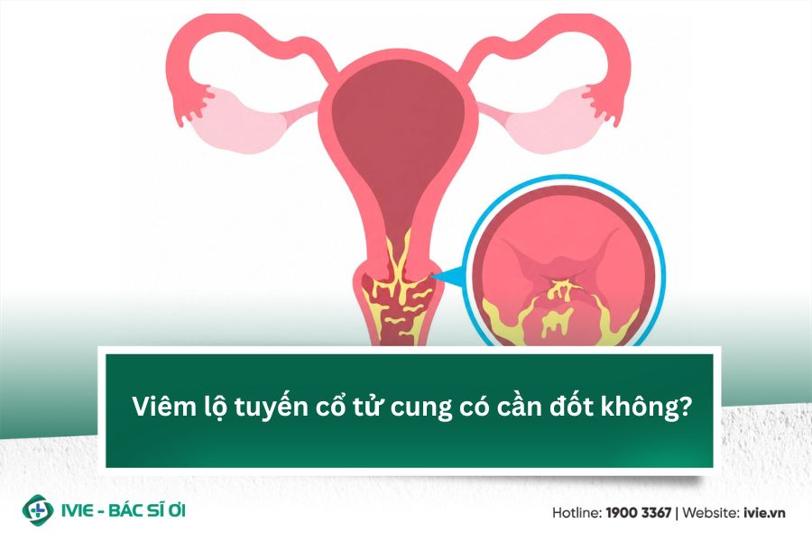 Viêm lộ tuyến cổ tử cung có cần đốt không?