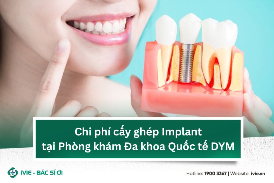 Chi phí cấy ghép Implant tại Phòng khám Đa khoa Quốc tế DYM