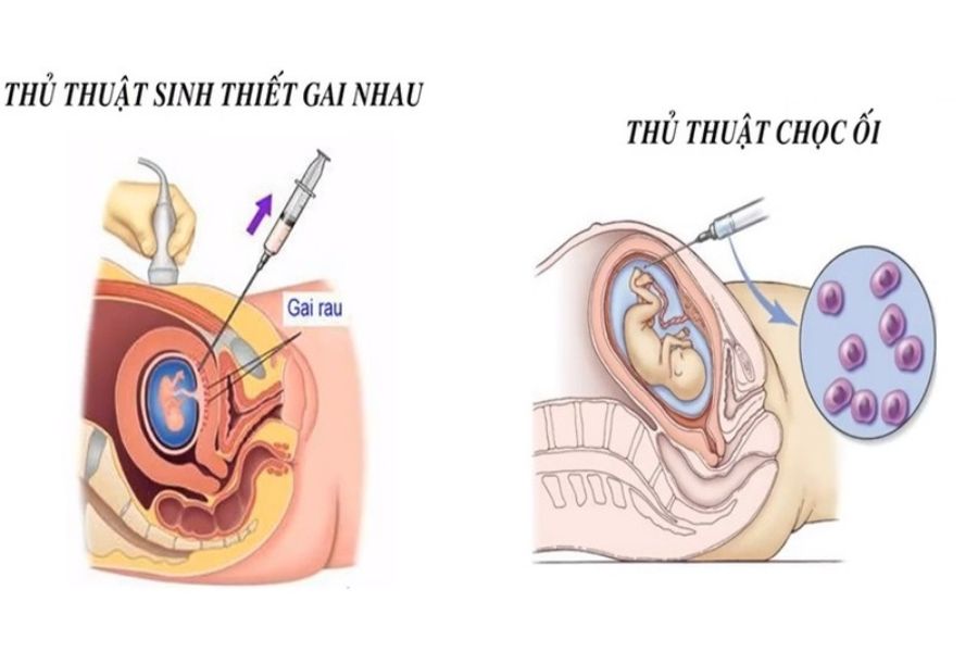 Quy trình 4 bước xử trí chuẩn y khoa khi nhận kết quả NIPT nguy cơ cao giúp mẹ bầu chủ động bảo vệ sức khỏe thai kỳ