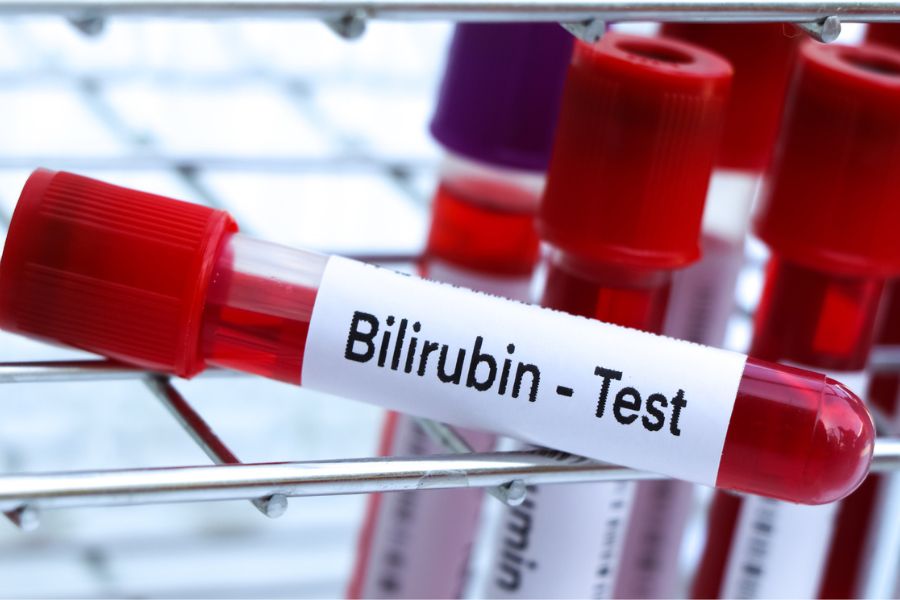 Xét nghiệm Bilirubin giúp tìm nguyên nhân vàng da, đánh giá bệnh gan mật và tình trạng tan máu ở người lớn, trẻ em và trẻ sơ sinh