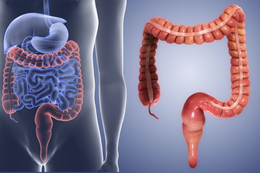 Viêm đại tràng mạn tính là tình trạng viêm kéo dài ở niêm mạc đại tràng, có thể do nhiều nguyên nhân
