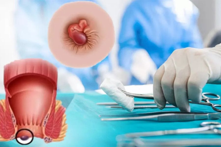 Trĩ huyết khối có thể điều trị bằng thuốc hoặc can thiệp, tùy mức độ bệnh và đánh giá của bác sĩ