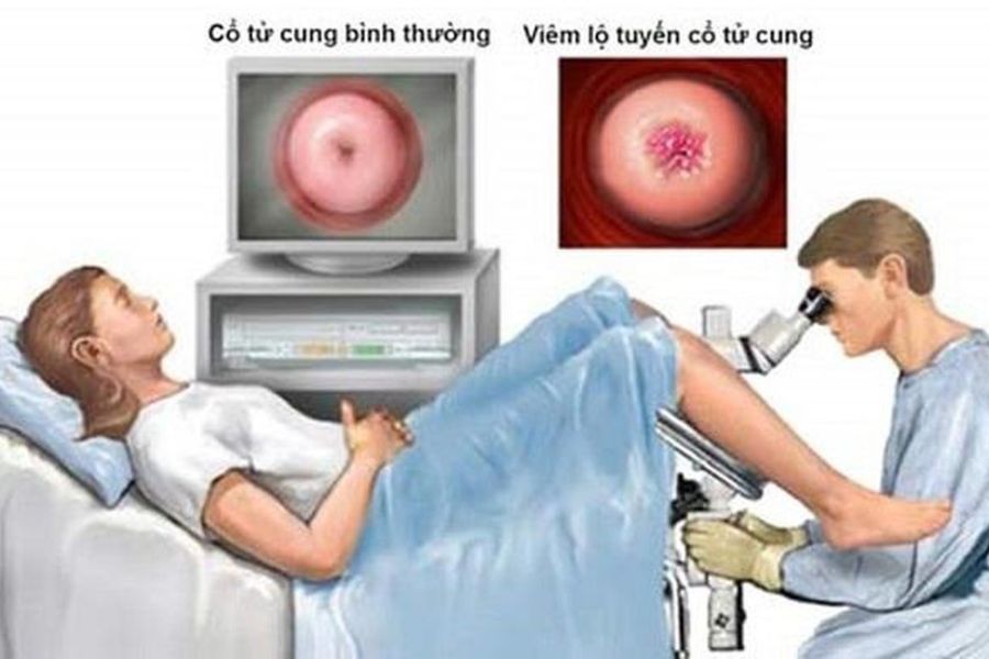 Quyết định điều trị viêm lộ tuyến cổ tử cung cần dựa trên chẩn đoán y khoa chính xác từ bác sĩ