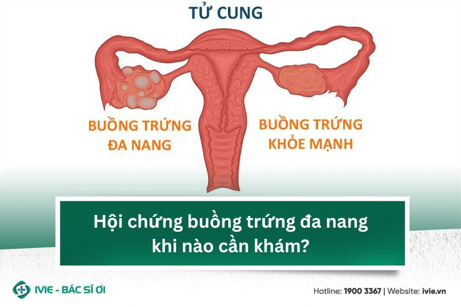 Hội chứng buồng trứng đa nang khi nào cần khám?