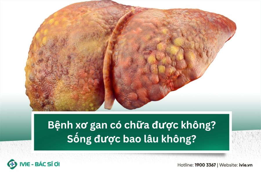 Bệnh xơ gan có chữa được không? Sống được bao lâu không?