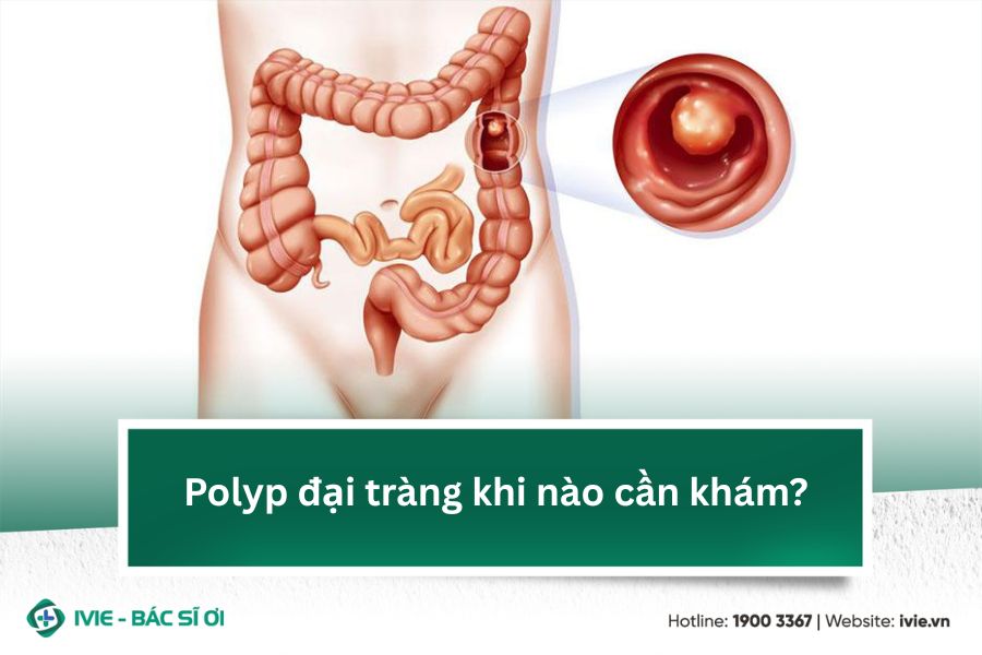 Polyp đại tràng khi nào cần khám?