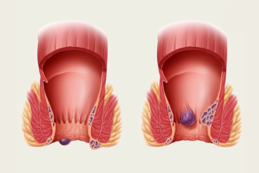 Trĩ ngoại huyết khối là búi trĩ có cục máu đông, thường sưng cứng, tím xanh và gây đau dữ dội đột ngột quanh hậu môn