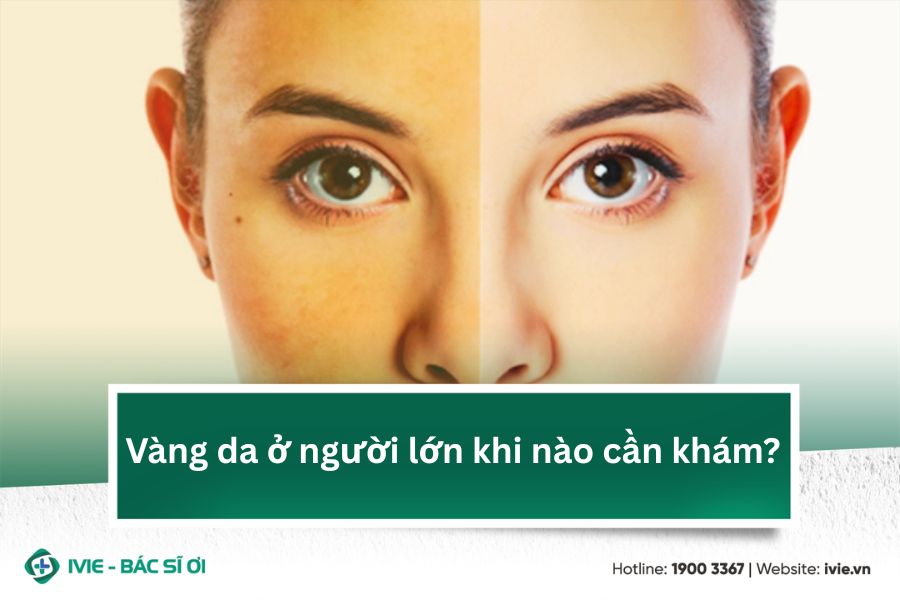 Vàng da ở người lớn khi nào cần khám?