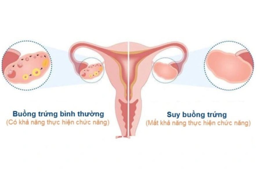 Suy buồng trứng sớm là tình trạng suy giảm chức năng buồng trứng trước tuổi 40, ảnh hưởng đến khả năng sinh sản