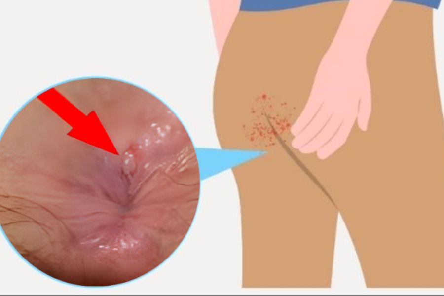 Nứt kẽ hậu môn là vết rách niêm mạc gây đau rát dữ dội và chảy máu tươi khi đi tiêu