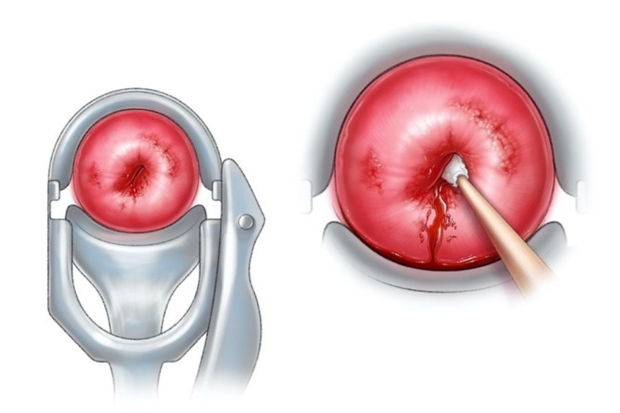 Viêm cổ tử cung có thể do nhiễm trùng hoặc kích ứng