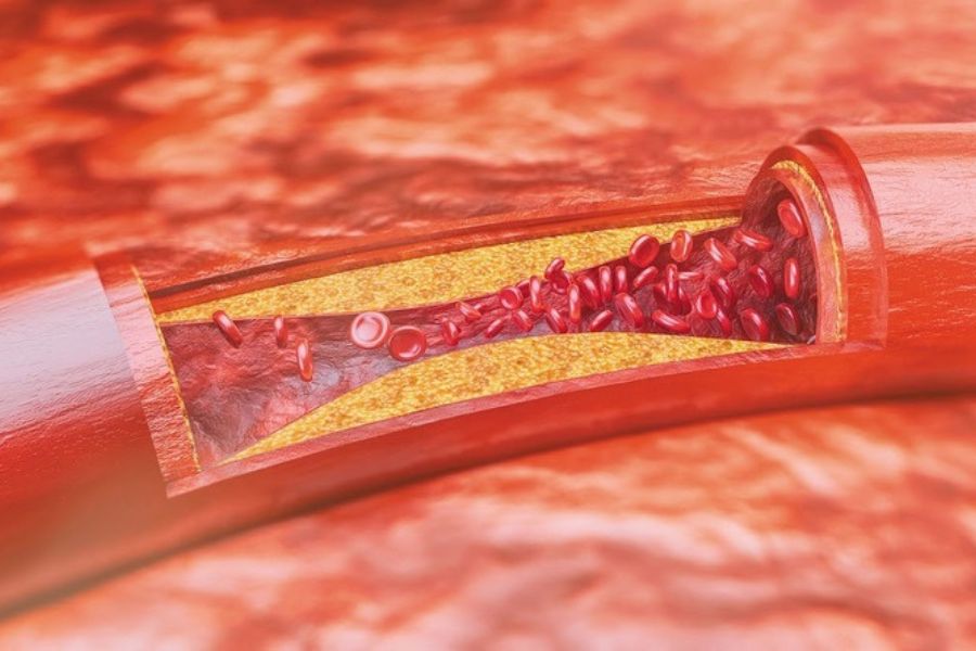 Kháng insulin và rối loạn lipid máu là những nguyên nhân hàng đầu gây nên gan nhiễm mỡ do rối loạn chuyển hóa