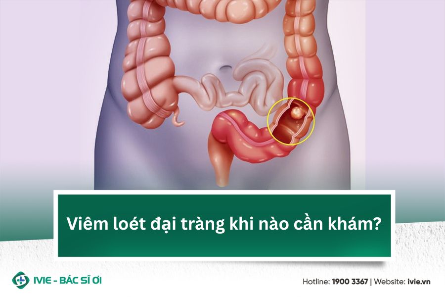 Viêm loét đại tràng khi nào cần khám?