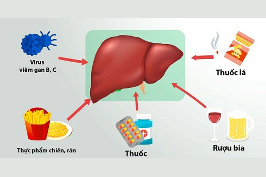 Không uống rượu bia, men gan vẫn có thể tăng do gan nhiễm mỡ, viêm gan virus, dùng thuốc hoặc tập luyện quá sức