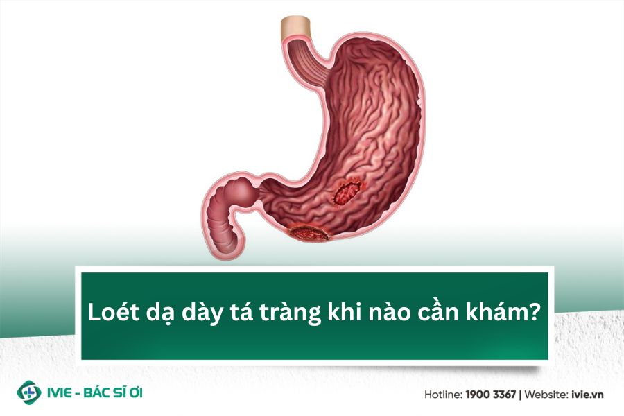 Loét dạ dày tá tràng khi nào cần khám?