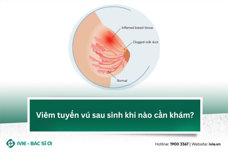 Viêm tuyến vú sau sinh khi nào cần khám?