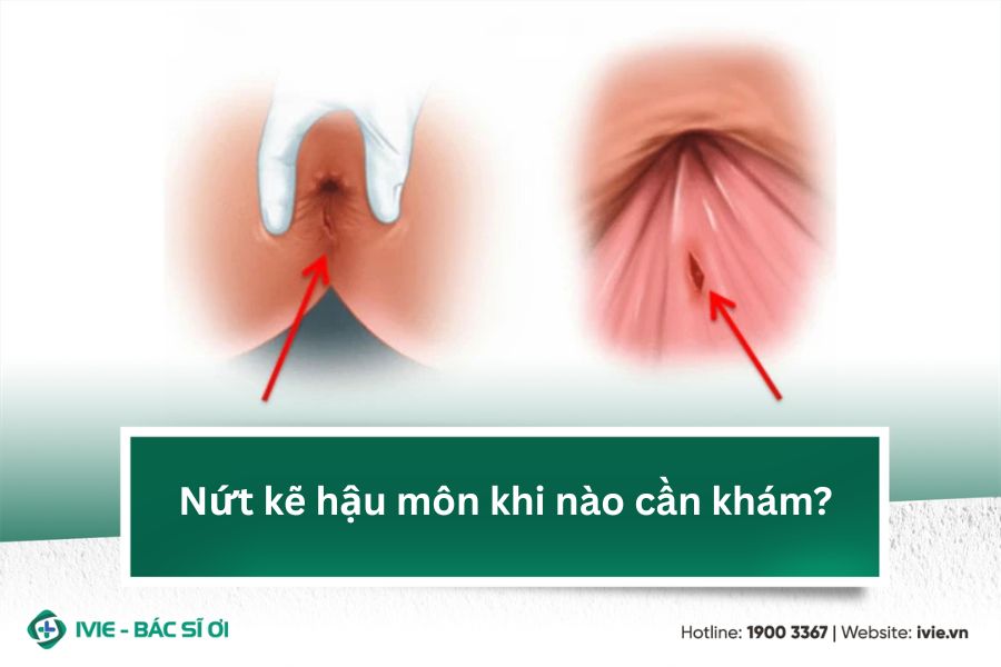 Nứt kẽ hậu môn khi nào cần khám?