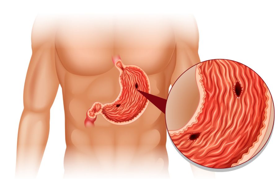 Viêm loét dạ dày - tá tràng và nhiễm vi khuẩn H. pylori là những nguyên nhân phổ biến gây đau thượng vị dai dẳng