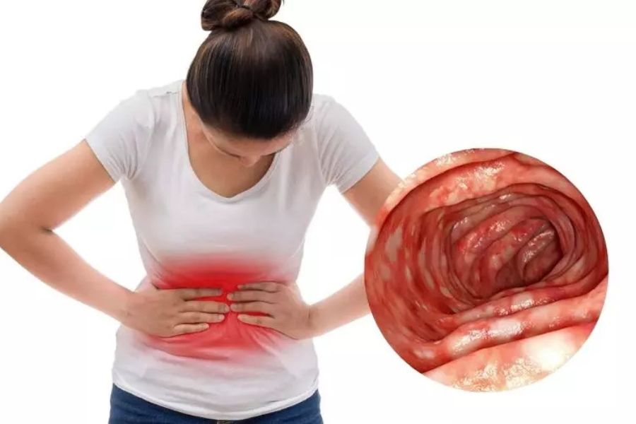 Đau bụng, tiêu chảy kéo dài, phân có máu hoặc nhầy và mót rặn là những dấu hiệu thường gặp của viêm loét đại tràng