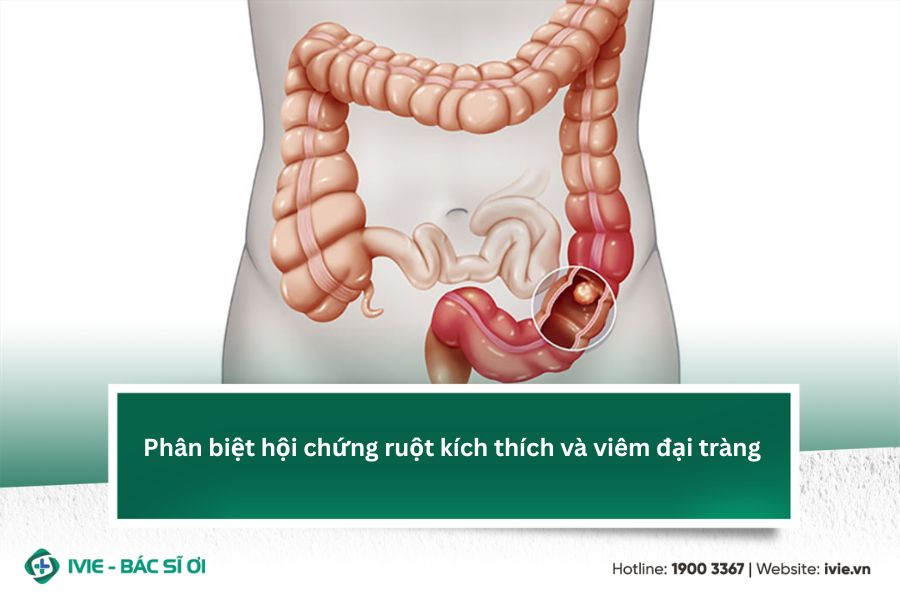 Phân biệt hội chứng ruột kích thích và viêm đại tràng