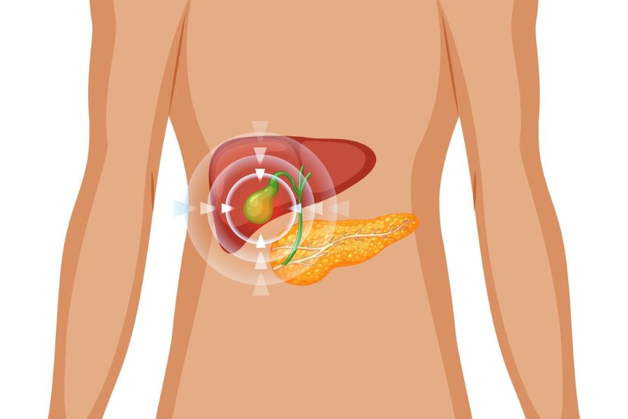 Túi mật bị viêm nhiễm cấp tính do tắc nghẽn dịch mật gây ra các cơn đau dữ dội vùng hạ sườn phải