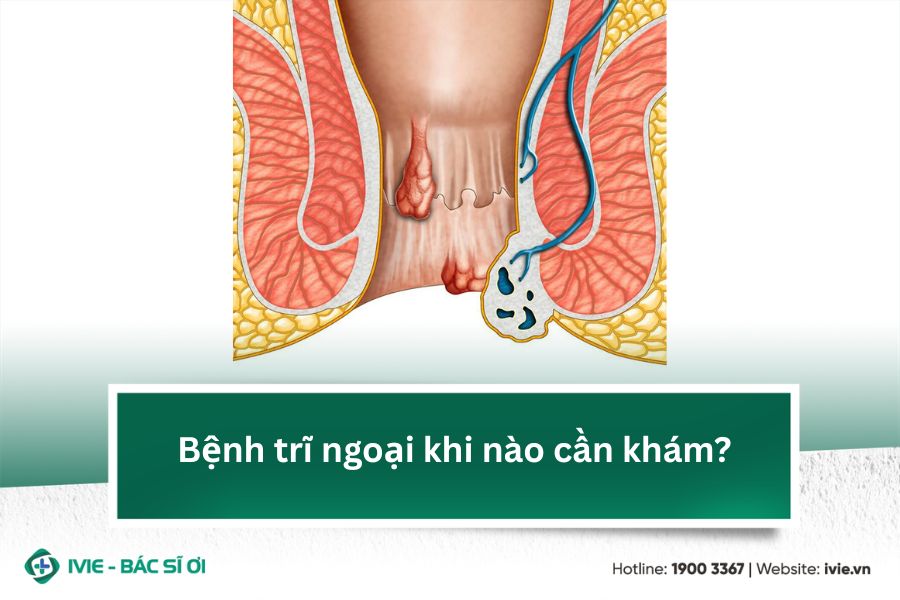 Bệnh trĩ ngoại khi nào cần khám?