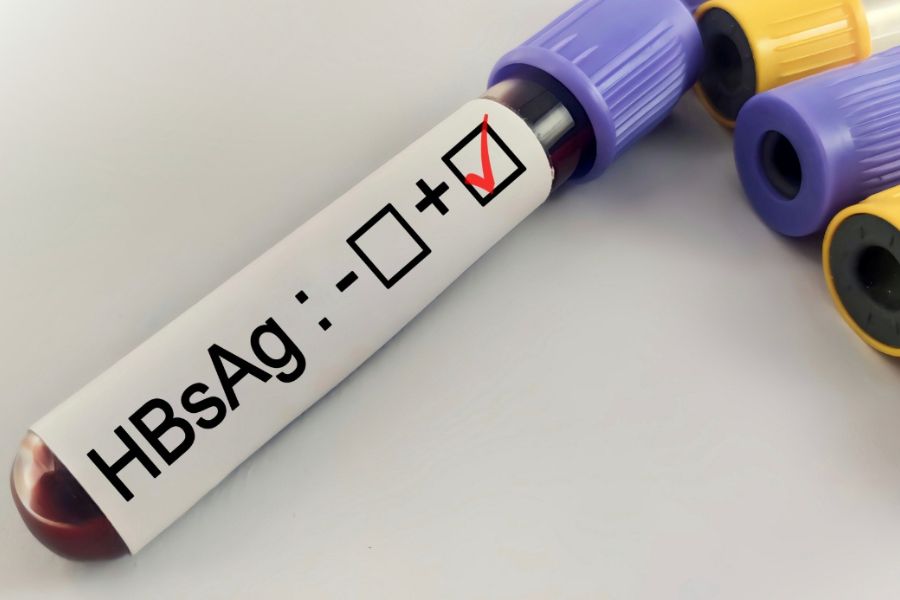Xét nghiệm HBsAg giúp sàng lọc nhiễm virus viêm gan B; kết quả cần được đọc theo ngưỡng tham chiếu của phòng xét nghiệm