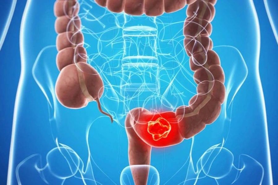 Nhiều nguyên nhân gây đi ngoài ra máu như bệnh trĩ, nứt kẽ hậu môn, polyp hay các bệnh lý viêm loét đường tiêu hóa