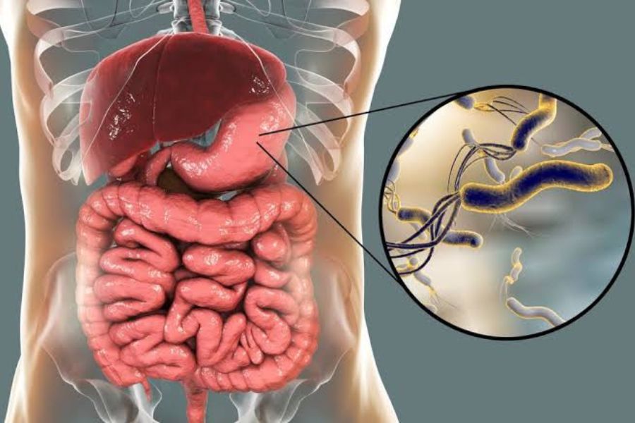 Vi khuẩn HP sống trong dạ dày, có thể gây viêm loét và làm tăng nguy cơ ung thư dạ dày