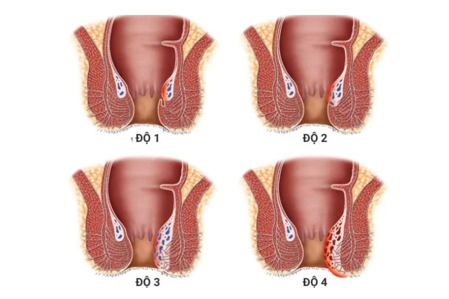 Trĩ nội được chia thành 4 độ, từ búi trĩ nằm bên trong đến sa ra ngoài và không thể đẩy vào