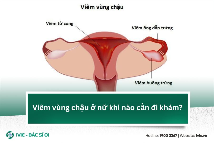 Viêm vùng chậu ở nữ khi nào cần đi khám?