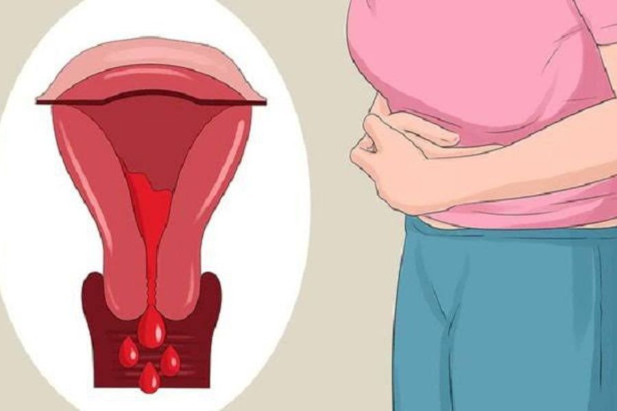 Đau bụng một bên kết hợp ra máu âm đạo bất thường là dấu hiệu cảnh báo quan trọng