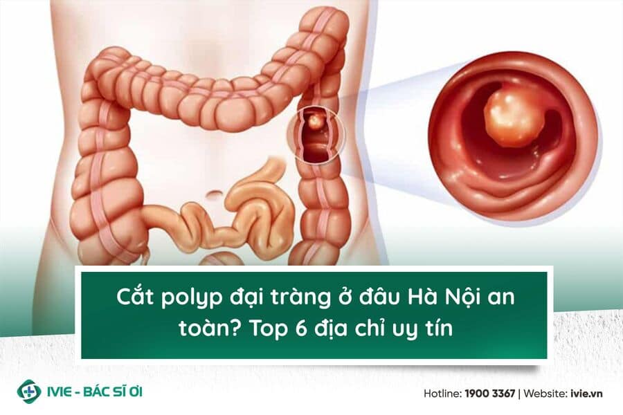 Cắt polyp đại tràng ở đâu Hà Nội an toàn? Top 6 địa chỉ uy...