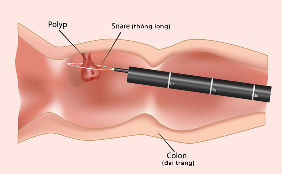Cắt polyp đại tràng ở đâu Hà Nội? Tìm hiểu về phương pháp cắt polyp đại tràng bằng máy nội soi tiêu hóa. 